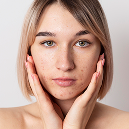 Removes-&-Prevents-Blackheads-and-Whiteheads Removes-&-Prevents-Blackheads-and-Whiteheads